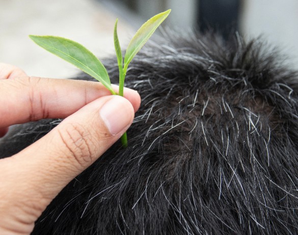 Transplante capilar: como funciona